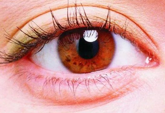 做双眼皮开眼角手术好吗