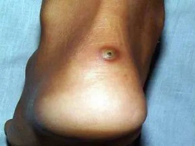 蚤病脚后跟小疙瘩图片