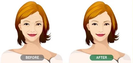 做拉皮除皱费用大概需要多少