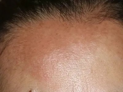 成人Still病症状图片