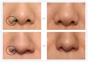 鼻翼缩小手术多少钱