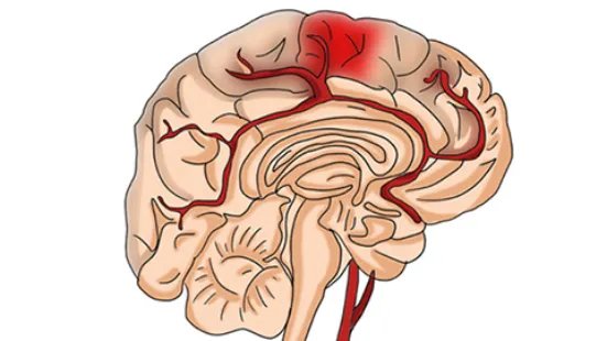高血压脑出血是什么