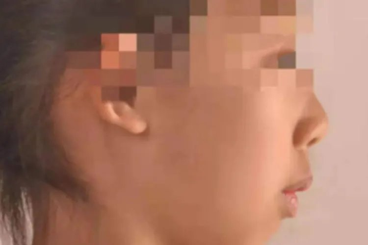 腺样体肥大的面容图片