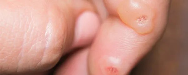 夏天手上起小水泡怎么回事