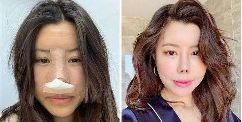 整容成猪鼻!韩国女星不小心撞断鼻子再次整容,术后仍像二师兄,你怎么看?