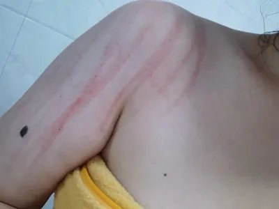 人工荨麻疹结痂图片