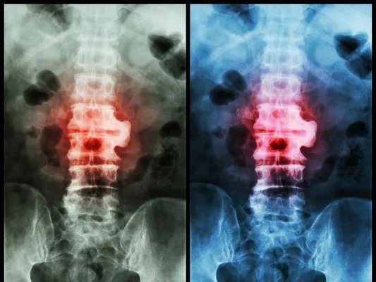 颈椎病的最佳治疗方法