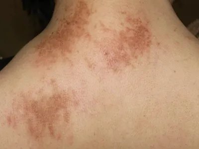 成人Still病症状图片