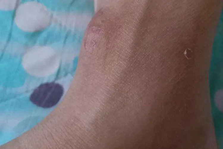 脚背腱鞘囊肿图片