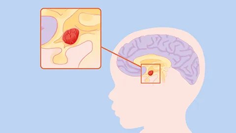 脑水肿后遗症有哪些