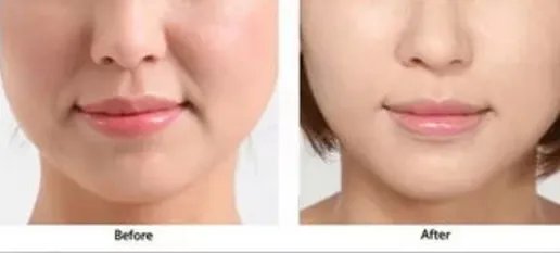 有法令纹怎么去除