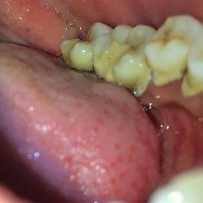 舌头疼是什么原因