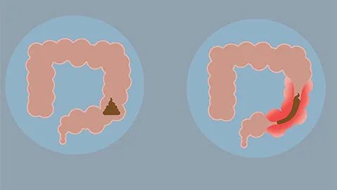 肠癌有什么症状