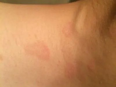 成人Still病症状图片