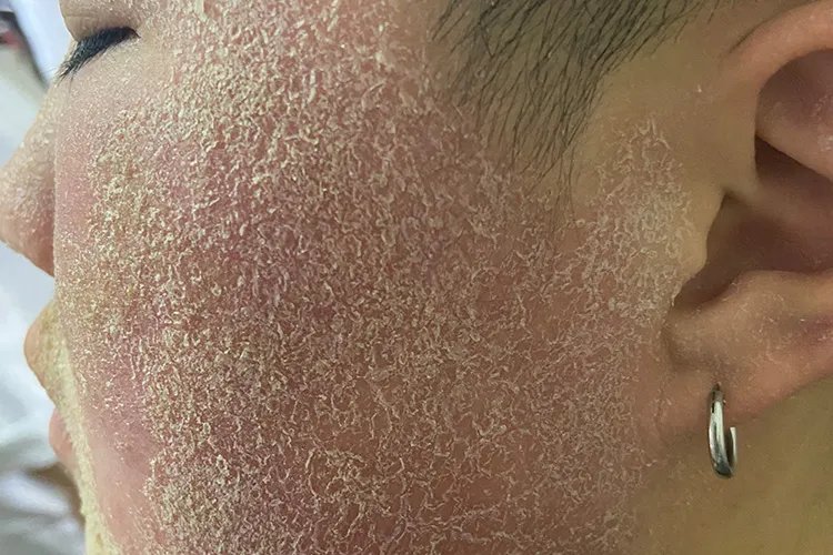 过敏性皮炎图片