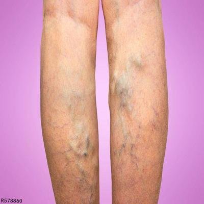 血小板减少的症状有哪些 浅析血小板减少的三个症状