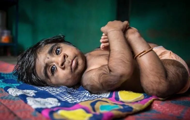 狼孩卡马拉的故事说明了什么问题 为什么没有形成人的正常心理