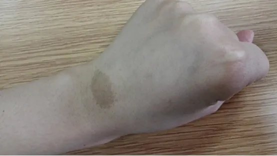 胎记是怎么形成的