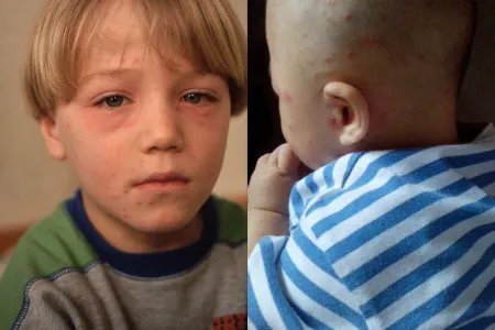 水痘初期症状图片展示