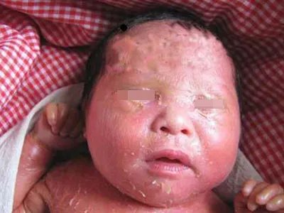 火棉胶婴儿面部症状图片