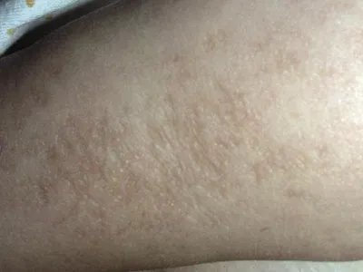 Pasini-Pierni进行性特发性皮肤萎缩斑图片