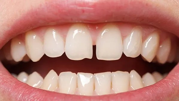 牙齿楔状缺损怎么办