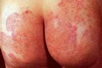 女性股癣图片初期图片