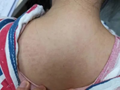 成人Still病症状图片