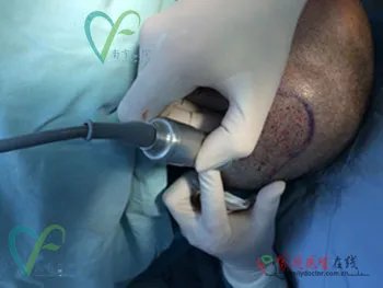 整形案例：揭秘毛发种植全过程