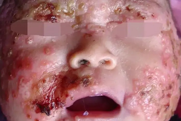 小儿慢性肉芽肿病图片