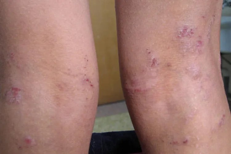 过敏性皮炎图片