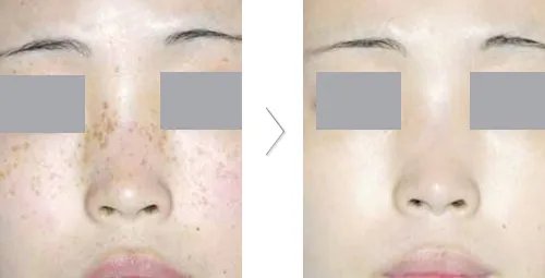 激光美容去斑价格是多少