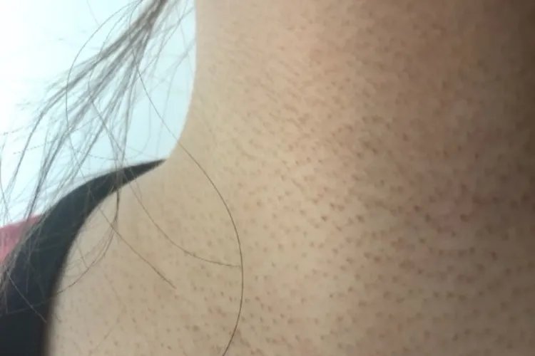 脖子上鸡皮肤图片