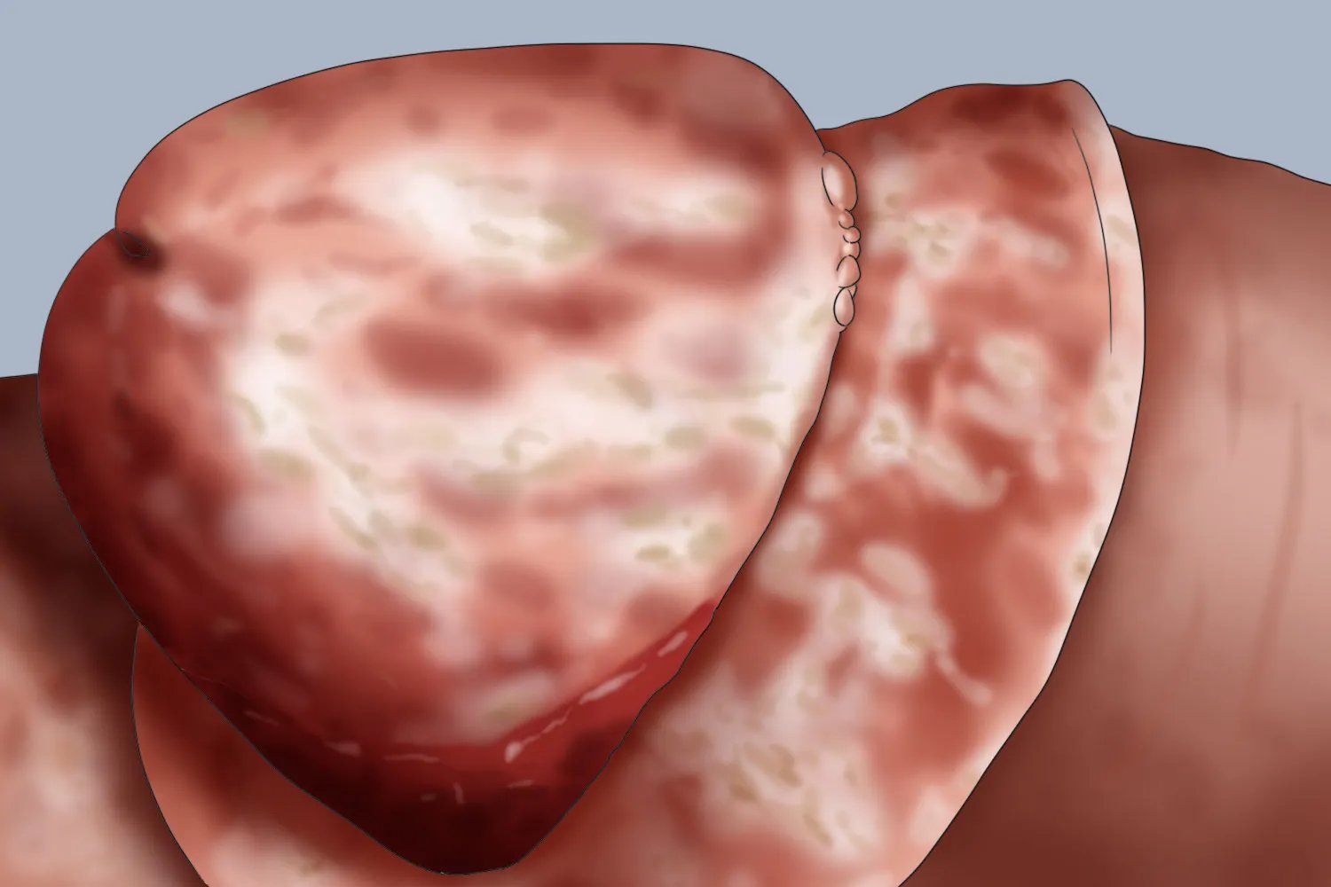 龟头炎的症状是什么样