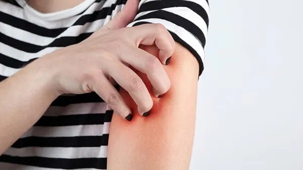 过敏性皮炎有效治疗方法