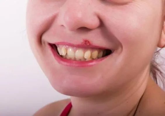 嘴唇上长小水泡怎么办