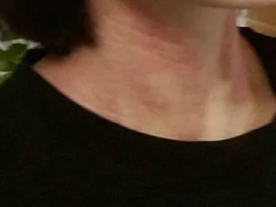 成人Still病症状图片