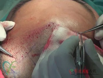 整形案例：揭秘毛发种植全过程