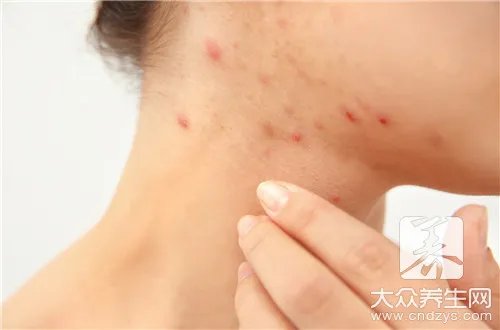 脓疱疮多久能好