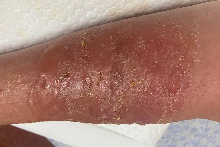 过敏性皮炎图片