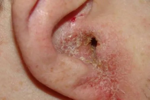 外耳道湿疹图片