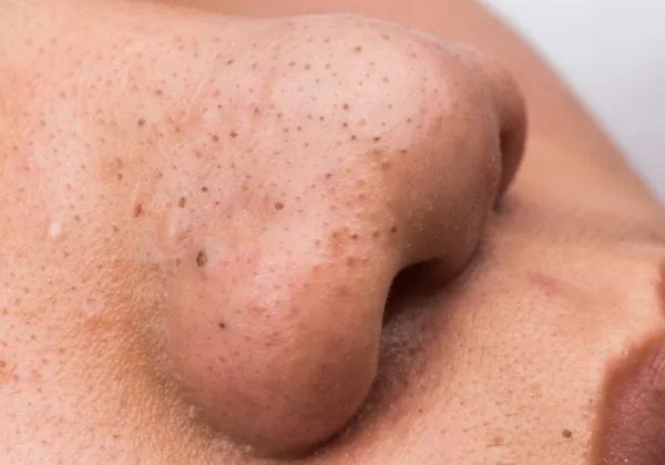 果酸怎么去黑头