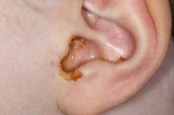 外耳道湿疹图片