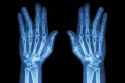 马凡氏综合征的病因有哪些 马凡氏综合征的3个原因须知