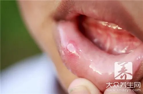 脓疱疮多久能好