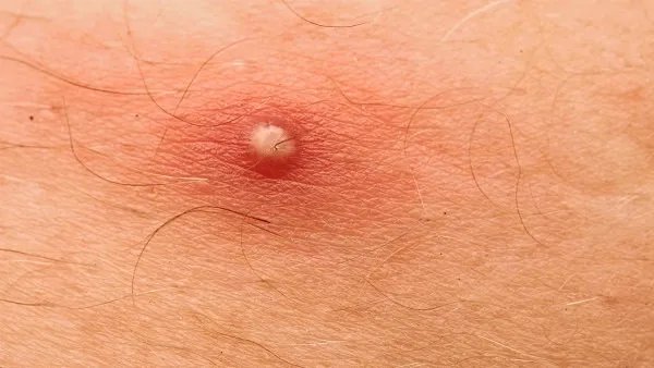 传染性软疣怎么根治