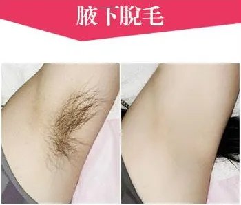 冰点脱毛价格是多少