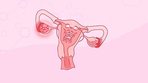 巧克力卵巢囊肿如何治疗