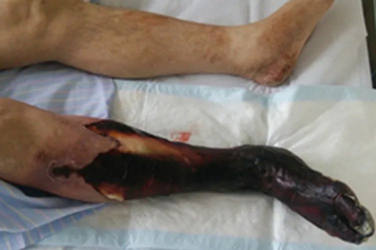 炭疽病小腿症状图片