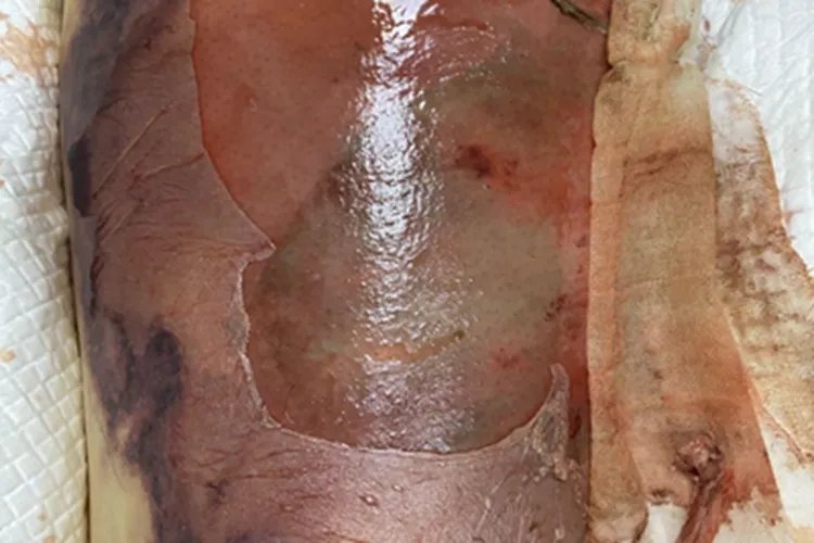 炭疽病小腿症状图片